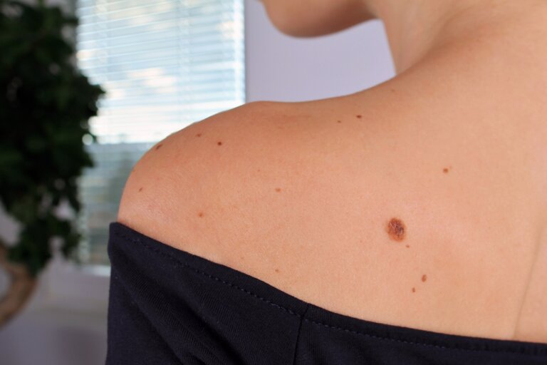 Woman with birthmarks on her skin, Checking benign moles. Skin tags removal